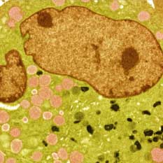 cells representing lysosomal disease